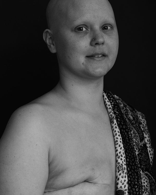 Georgia Devey Smith - After my mastectomy